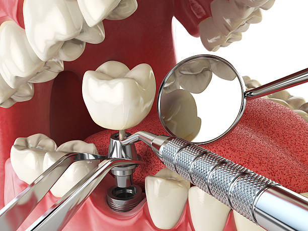 Best Emergency Root Canal Treatment in Camp Springs, MD
